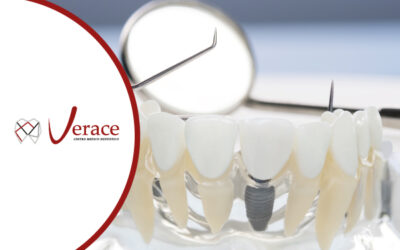 Impianti Dentali: la guida completa con tutto ciò che devi sapere